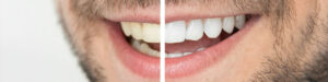 Tratamiento Blanqueamiento Dental en Oviedo