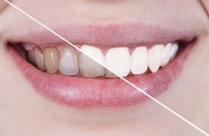 Tipos de blanqueamiento dental