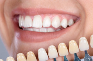 Carillas Dentales ¿son el tratamiento indicado para ti?