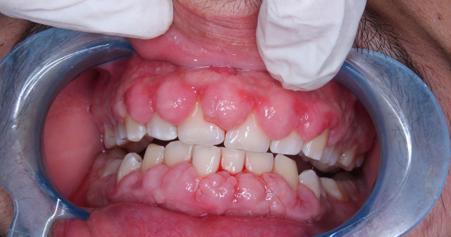 Agrandamiento Gingival en Oviedo