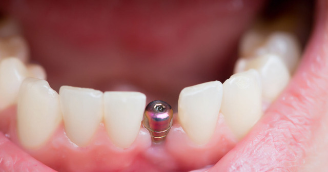 Implantes Dentales Oviedo