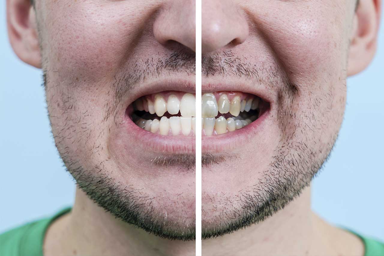 Diferencias entre carillas y coronas dentales - Clínica Dental Blanco  Moreno Oviedo, Asturias